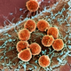 Immune cells attacking a tumor. (Image: Memorial Sloan Kettering Cancer Center)